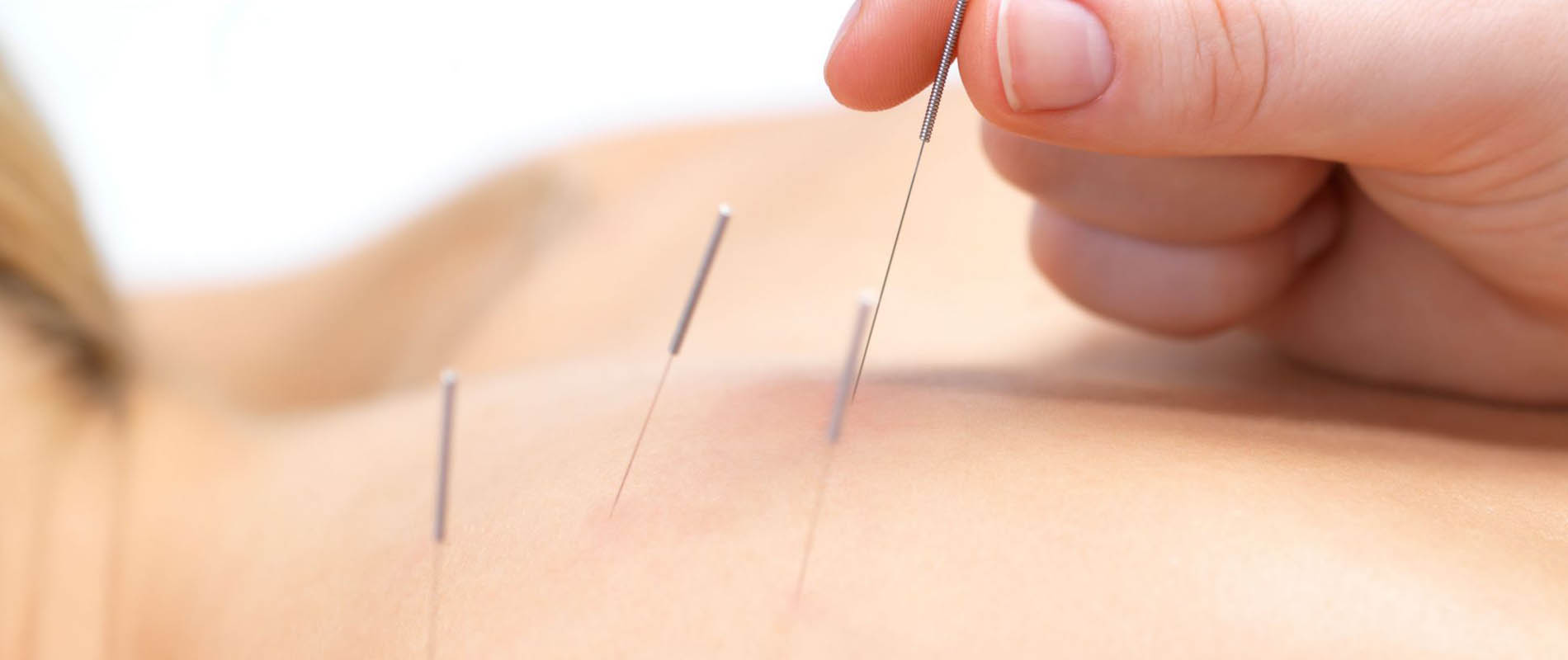 What is Acupuncture?