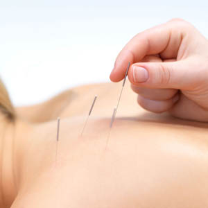 Acupuncture Treatment