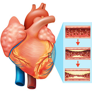 Cardiovascular Disease 2